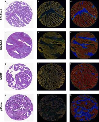 Spatial distribution of CD3- and CD8-positive lymphocytes as pretest for POLE wild-type in molecular subgroups of endometrial carcinoma